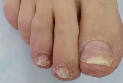 Las uñas estaban muy afectadas por el hongo