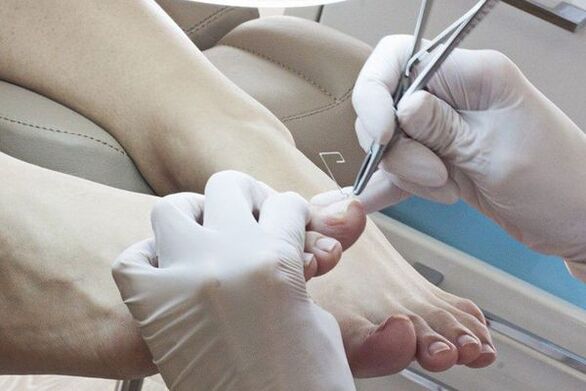 Eliminación mecánica de uñas afectadas por hongos