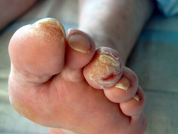Pie diabético y onicomicosis