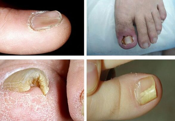 Síntomas de onicomicosis en las piernas